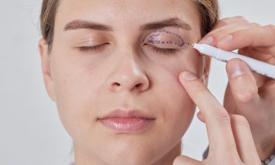 blefaroplastie nechirurgicala cu microplasma